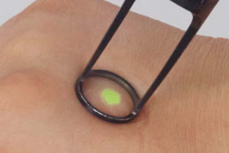 Qスイッチルビーレーザー